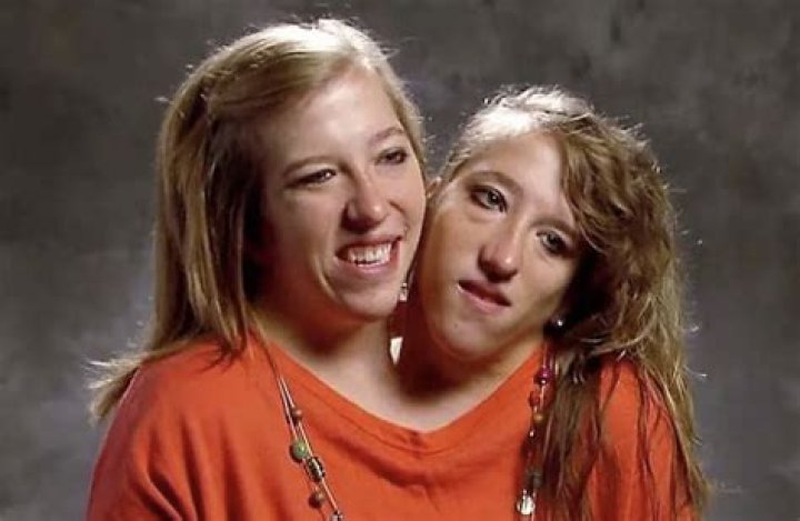 Understanding Abby and Brittany Hensel: The Remarkable Journey of Conjoined Twins