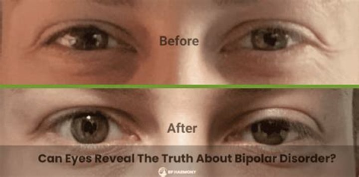 Bipolar Eyes: Understanding the Unique Phenomenon of Color Changing Eyes