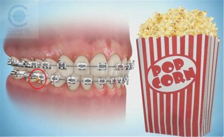 Can You Eat Popcorn with Braces? The Ultimate Guide