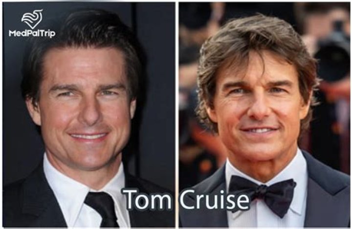 A-list Celebrities with Crooked Noses: Embracing Imperfections