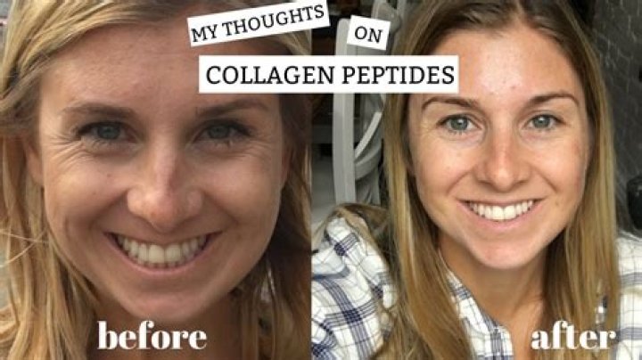 Transformative Effects of Collagen Peptides: Before and After