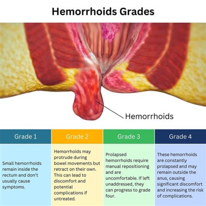 Understanding Hemorrhoids: Do They Smell?