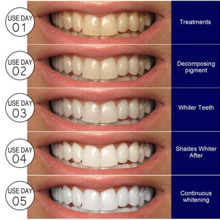 Unveiling the Truth: Do Teeth Whitening Strips Work?