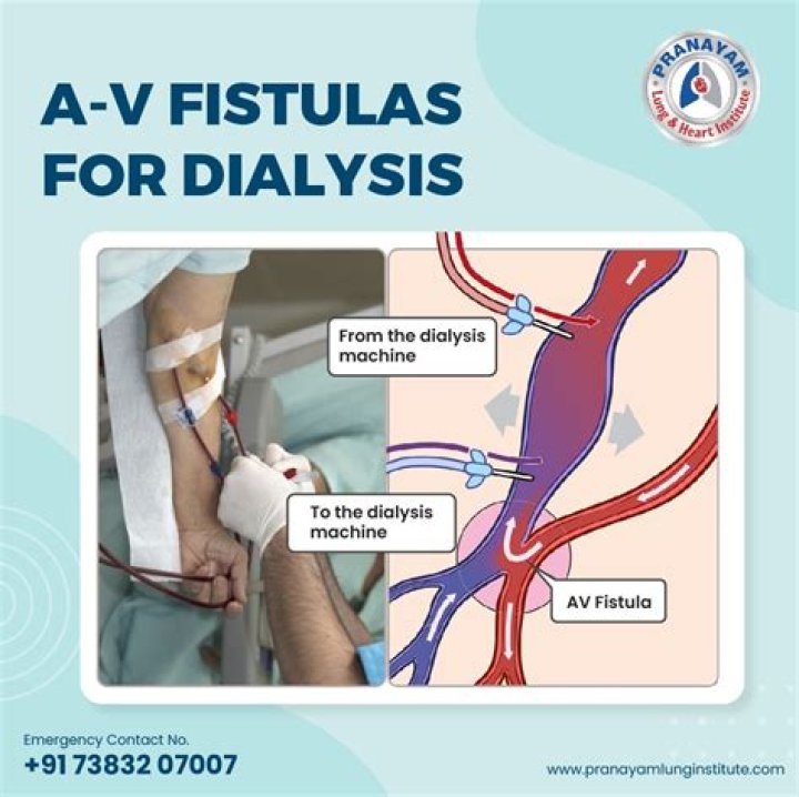 Understanding Fishler for Dialysis: A Comprehensive Guide