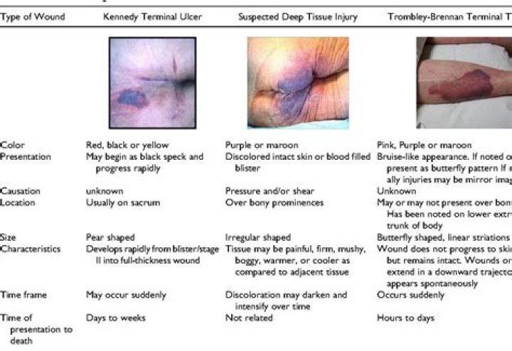 Exploring Kennedy Ulcer Pictures: Understanding and Awareness