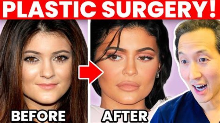 Kylie Jenner Before Surgery and After Surgery: A Comprehensive Transformation Analysis