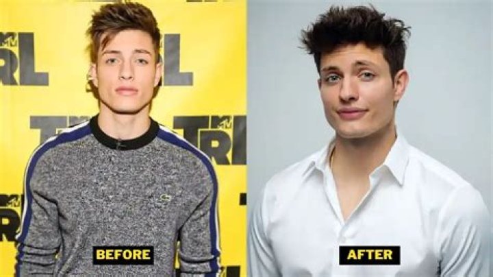 Unveiling the Journey: Matt Rife Before Plastic Surgery