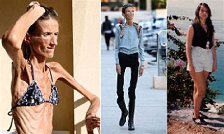 Skinniest People in the World: A Closer Look at Extreme Thinness