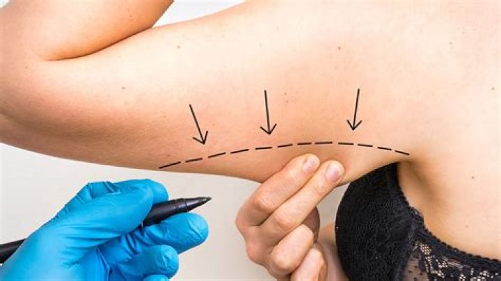 Understanding Sono Bello Costs: What You Need to Know Before Your Procedure